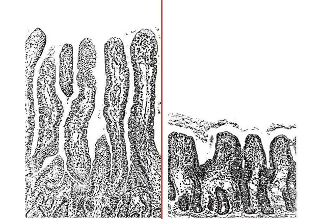 正常的肠绒毛vs损伤的肠绒毛